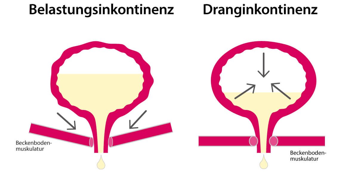 Schematische Darstellung der beiden häufigsten Formen der Harninkontinenz Schematische Darstellung der beiden häufigsten Formen der Harninkontinenz