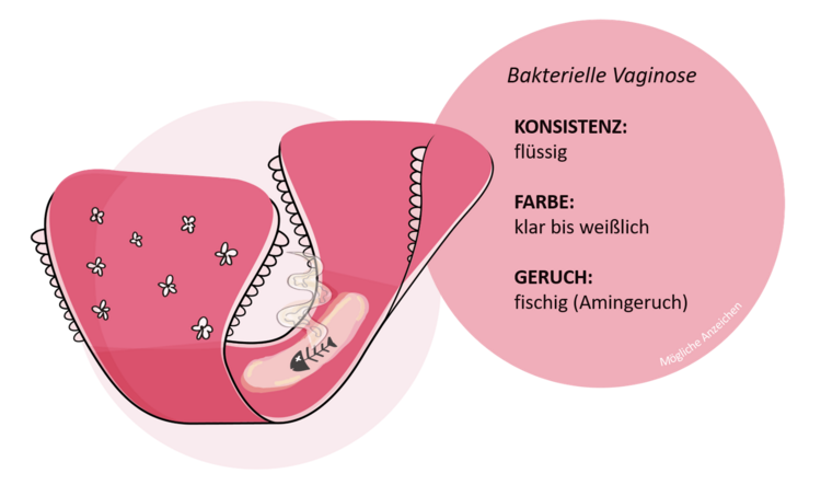 Vaginaler Ausfluss: Mögliche Anzeichen für eine Bakterielle Vaginose Vaginaler Ausfluss: Mögliche Anzeichen für eine Bakterielle Vaginose