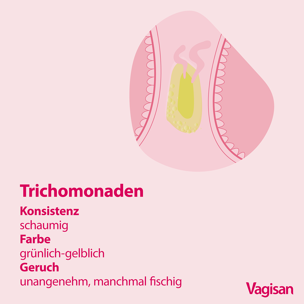 Illustration eines Slips mit grün-gelbem Scheidenausfluss und Angaben zu Konsistenz und fischigem Geruch bei einer Infektion mit Trichomonaden 