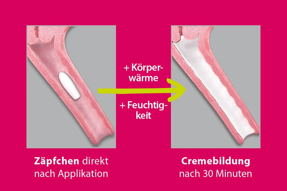 Warum Zäpfchen Mit Der Stumpfen Seite www.vagisan.com