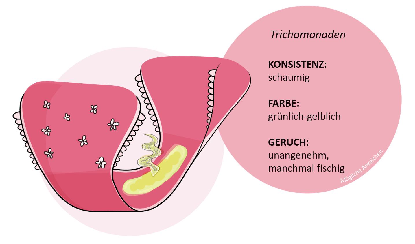 Charakteristika krankhafter Formen von Ausfluss mit möglichen Anzeichen für eine Vaginalmykose oder Trochomoniasis