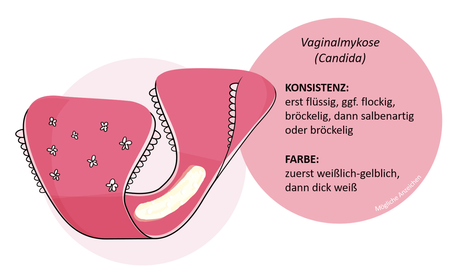 Charakteristika krankhafter Formen von Ausfluss mit möglichen Anzeichen für eine Vaginalmykose oder Trochomoniasis